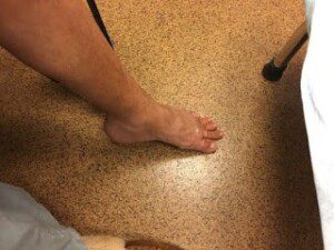 Tracy Coval's foot 2 weeks after surgery. Foot was regaining some normalcy with CRPS and dystonia