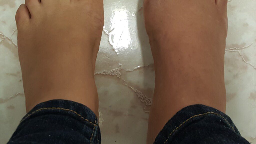 Jeannette Pellot CRPS feet2