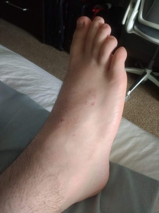 CRPS foot after Calmare theraphy