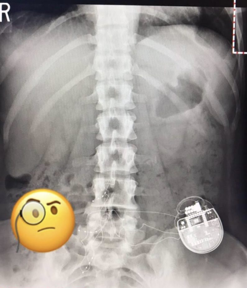 X-ray with a back stimulator
