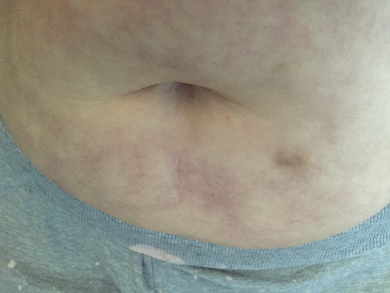 Nurse Beth's stomach while CRPS and GI issues were flaring