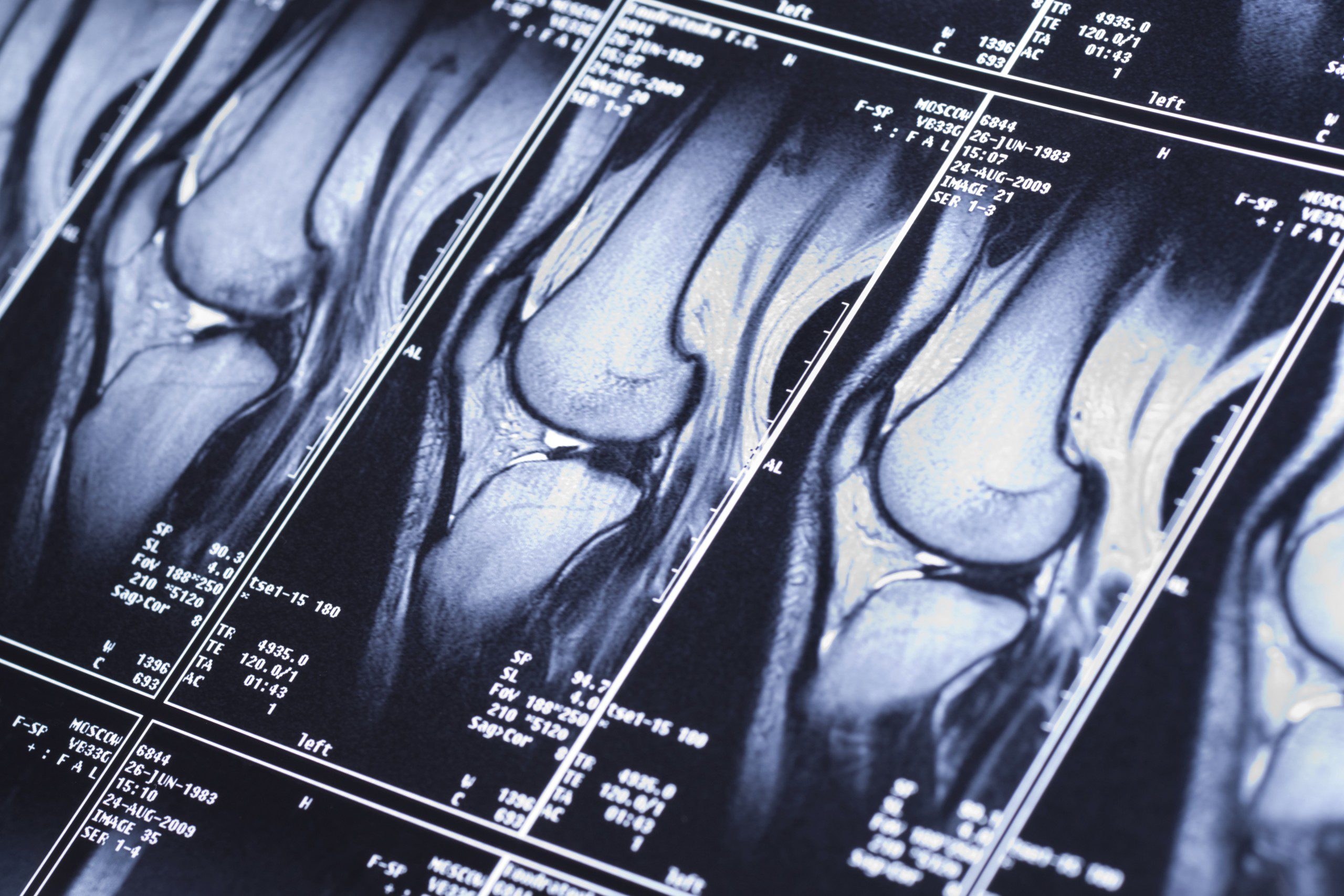How Are Bone Scans Used in the Diagnosis and Treatment of CRPS?